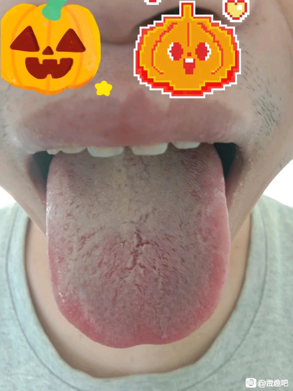 ”我好像真得静脉漏了！