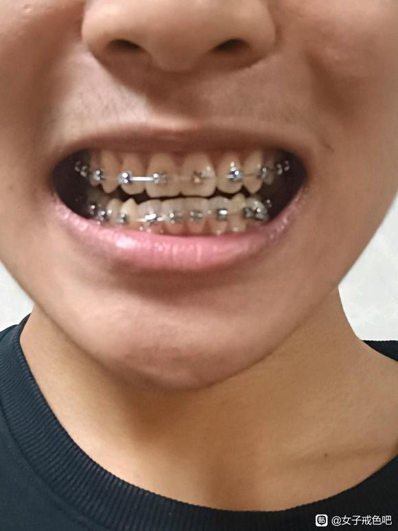 ”关于手淫导致的牙齿松动会改善吗