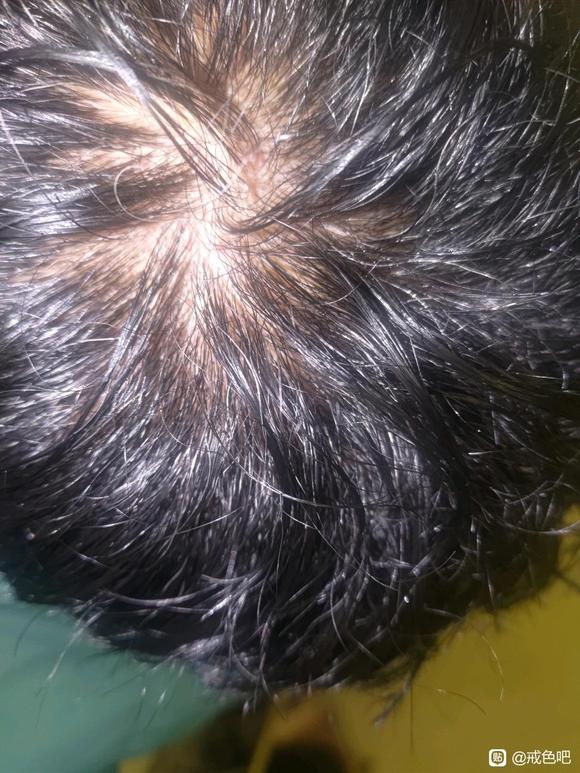 ”各位师兄！真的怕了！今年一月份开始断断续续戒，头发掉得好严重啊