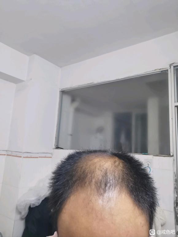 ”谁有脱发的通过戒色恢复的吗？