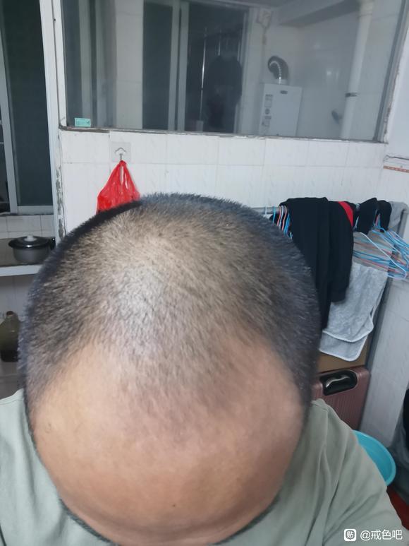 ”谁有脱发的通过戒色恢复的吗？