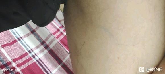 ”下肢静脉曲张精索静脉曲张