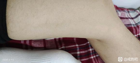 ”下肢静脉曲张精索静脉曲张