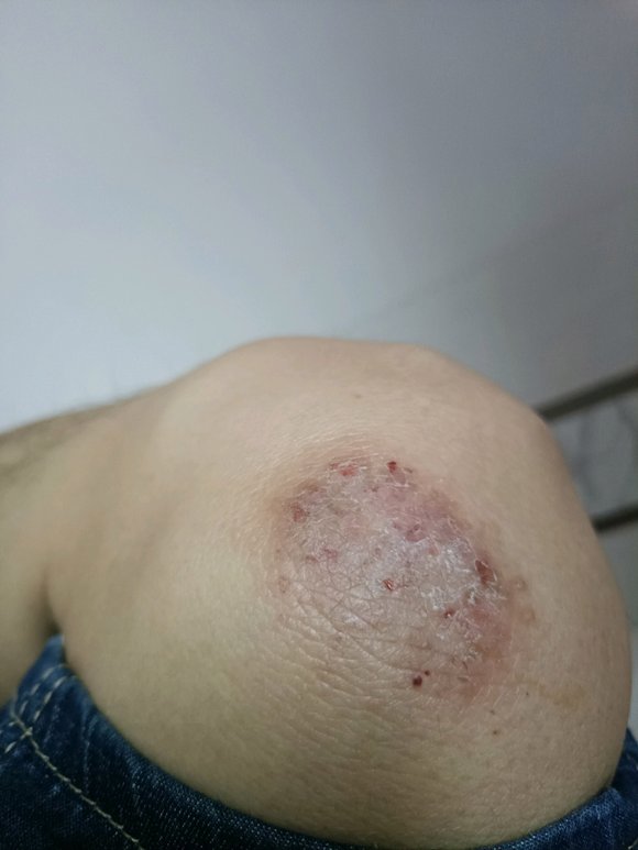 ”xdm我这个是什么皮肤病