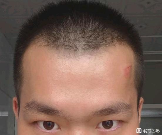 ”太阳穴凹陷真的能恢复吗戒色有没有我这种类型的？没有看到案例