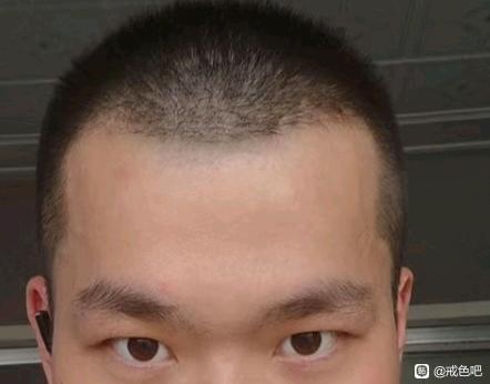 ”太阳穴凹陷真的能恢复吗戒色有没有我这种类型的？没有看到案例