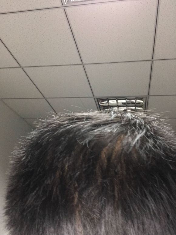 ”sy后的造成的脂溢性脱发