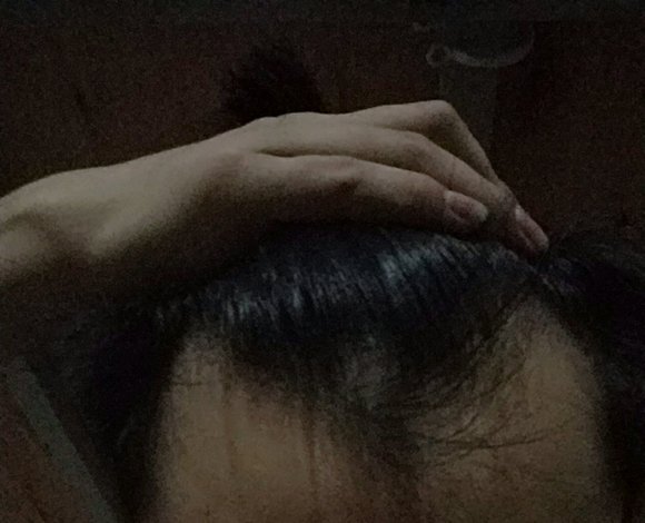 ”发际线后移，这种还有救吗