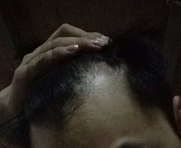 ”发际线后移，这种还有救吗