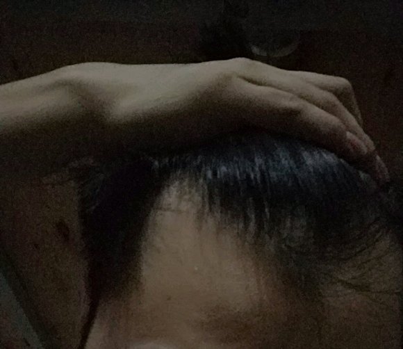 ”发际线后移，这种还有救吗