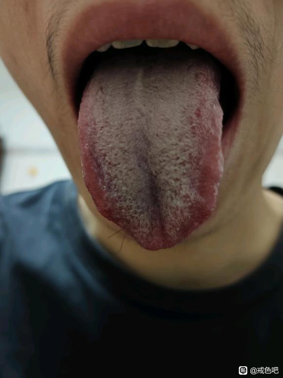 ”肾虚失眠男科前列腺炎精索静脉曲张