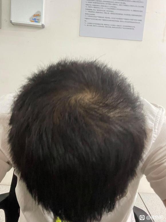 ”我这个算在恢复吗？