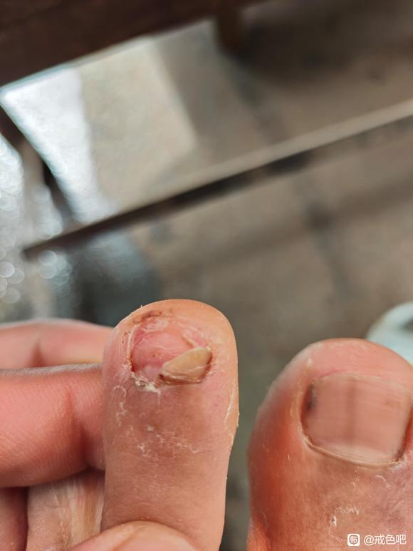 ”老哥们指甲这样还能再长出来吗