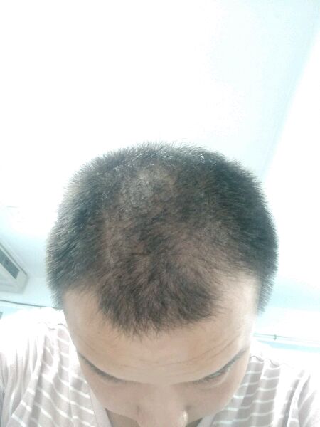 ”戒色三月了，右侧鬓角脱发厉害现