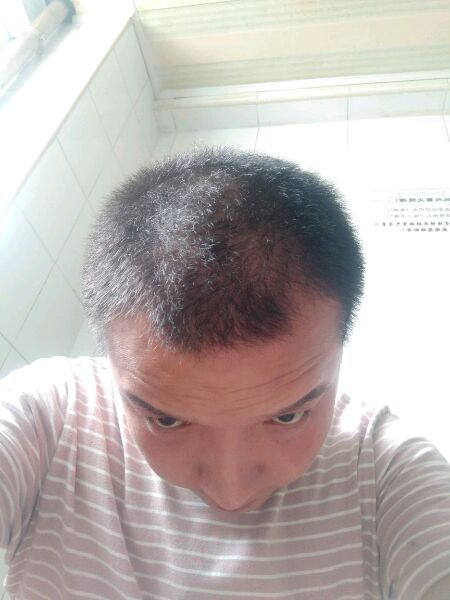 ”戒色三月了，右侧鬓角脱发厉害现