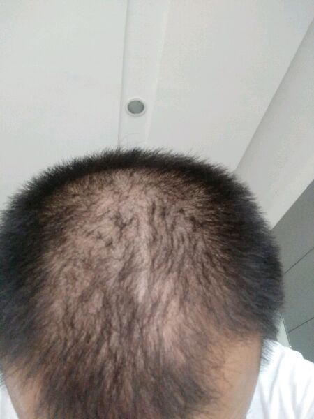 ”戒色三月了，右侧鬓角脱发厉害现