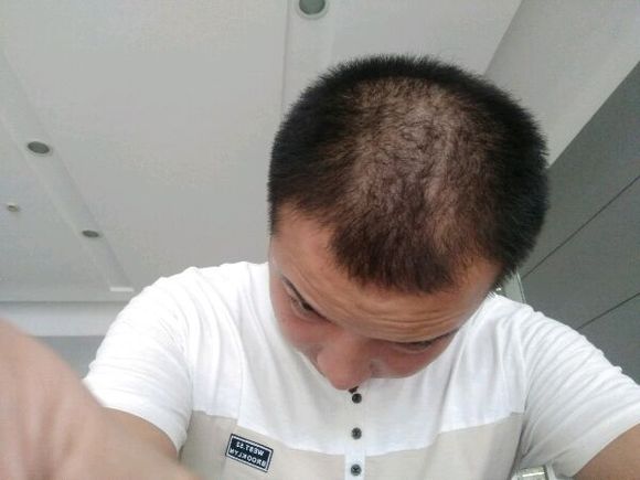 ”戒色三月了，右侧鬓角脱发厉害现