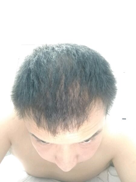 ”戒色三月了，右侧鬓角脱发厉害现