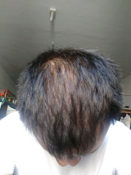 ”戒色三月了，右侧鬓角脱发厉害现