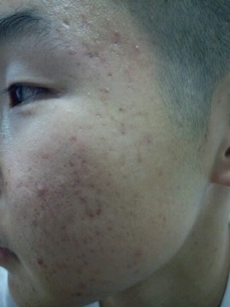 ”【成长记录】记录脸部气色等改善