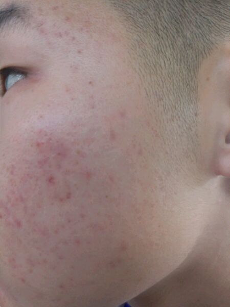 ”【成长记录】记录脸部气色等改善