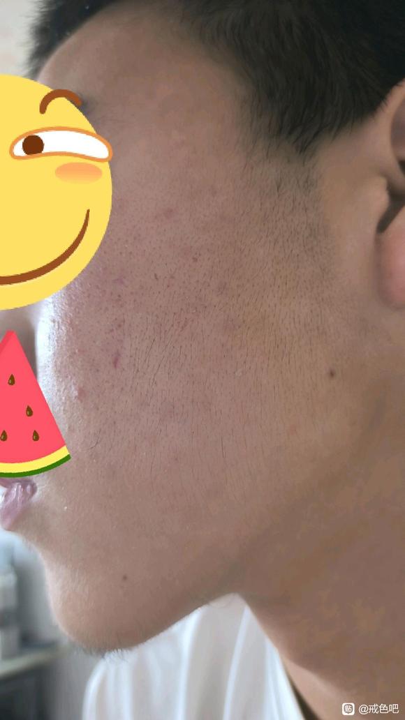 ”吧友们，这是不是内分泌失调引起的