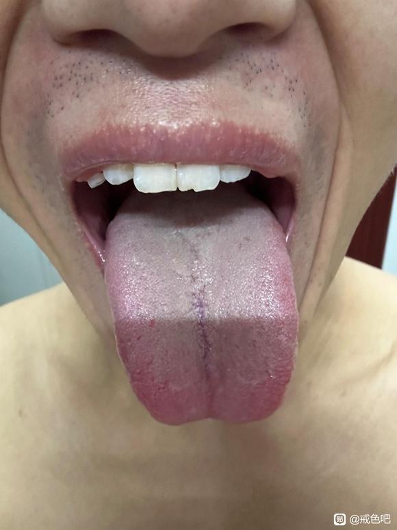 ”本人有慢性前列腺炎，最近一直在吃药，晨跑还是夜跑效果好啊？