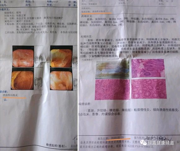 ”吃药无数，被溃结直肠炎折磨得没办法的我，终于找到好的方法!