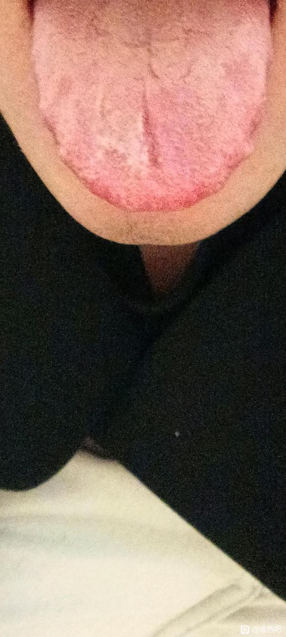 ”舌苔很厚，发白，发黄，有裂纹