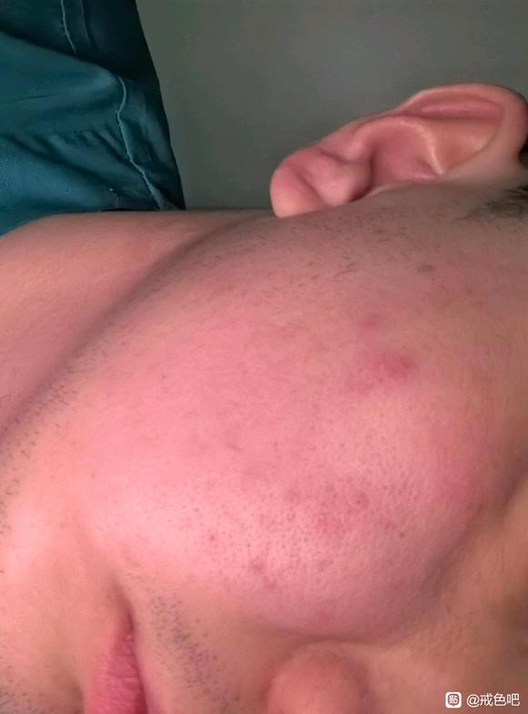 ”痘痘问题怎么办