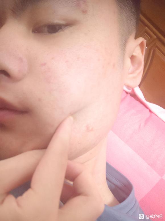 ”有人跟我一样的情况吗，长了这种痘痘就消不掉。