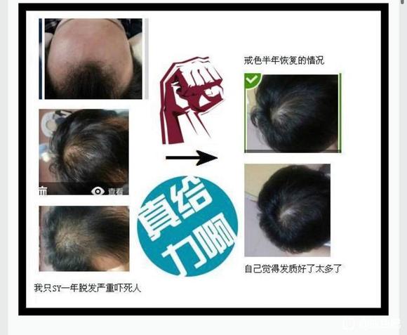 ”前辈有没有戒了之后头发恢复乌黑亮丽的案例