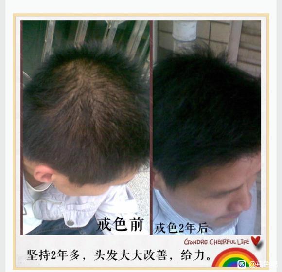 ”前辈有没有戒了之后头发恢复乌黑亮丽的案例