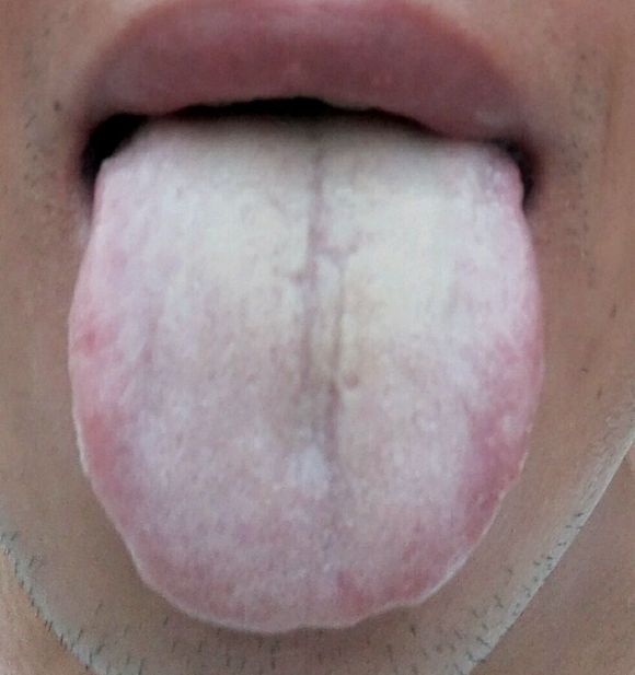 ”【问题求助】有没有和我一样的。打嗝嗳气，腹胀不消化，乏力头沉