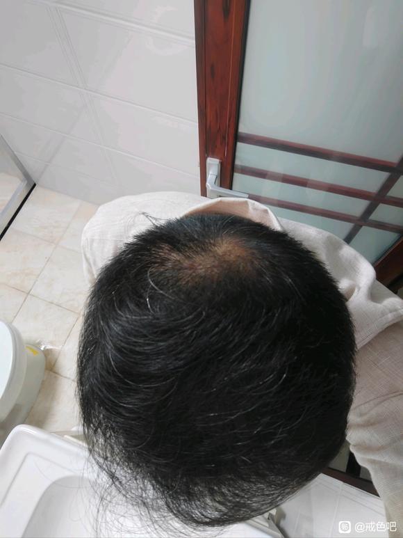 ”戒色前后，头发恢复对比