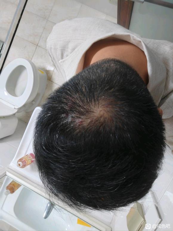 ”戒色前后，头发恢复对比