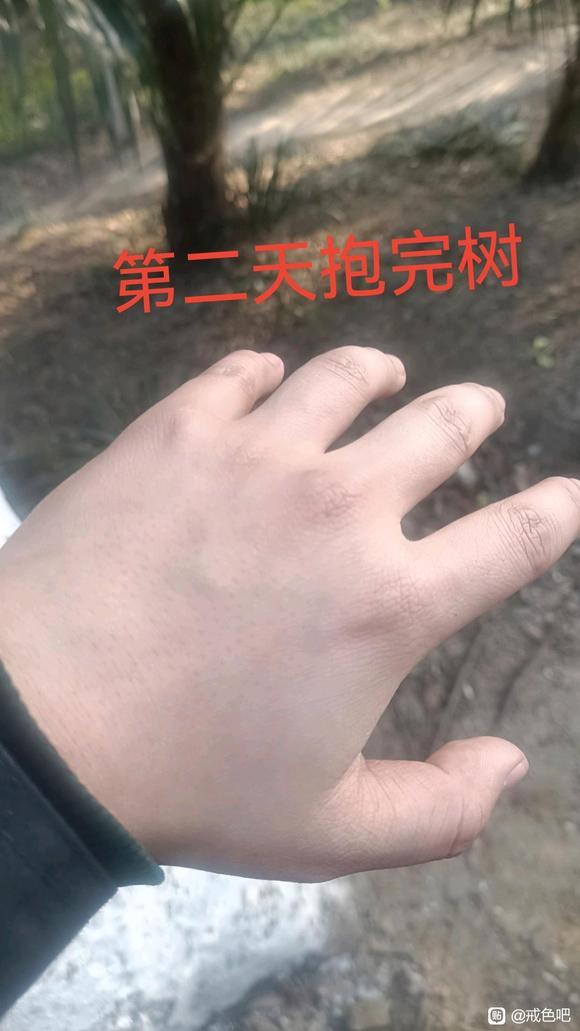 ”树疗的效果真的太好了