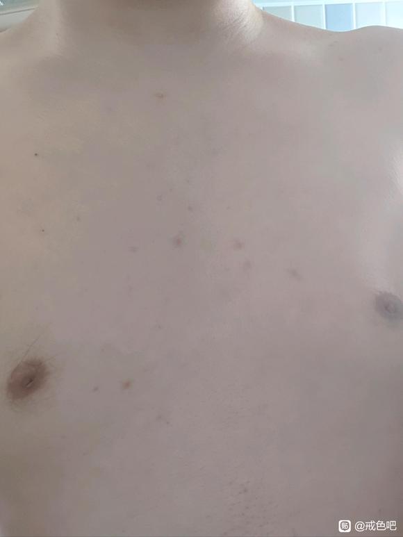 ”兄弟们这咋办痒的很前胸后背都是，想死了