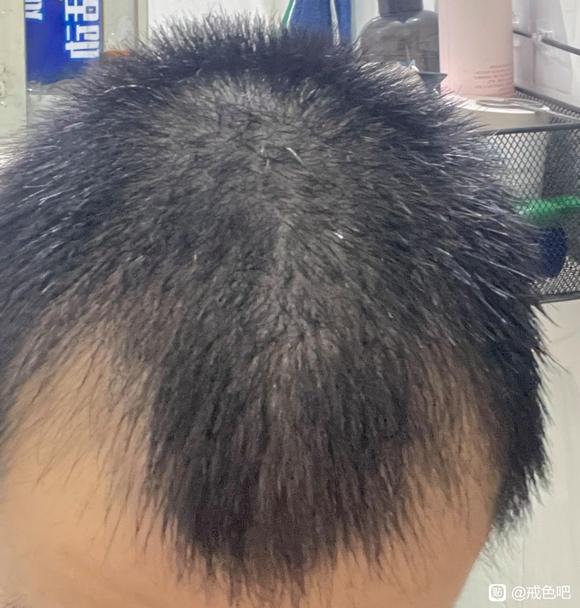 ”邪淫导致的脱发恶报