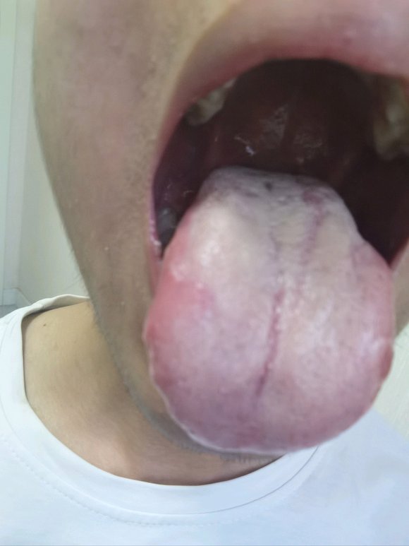 ”舌苔经常这样，总是口臭咋办