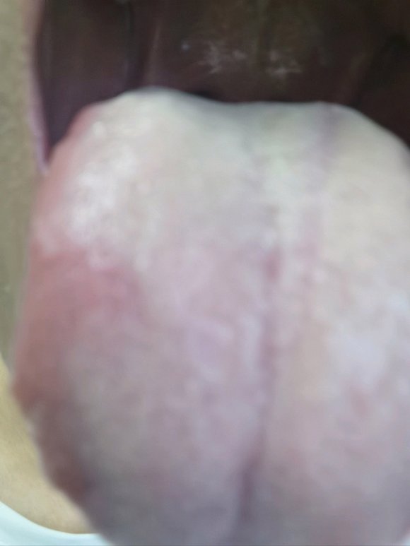 ”舌苔经常这样，总是口臭咋办