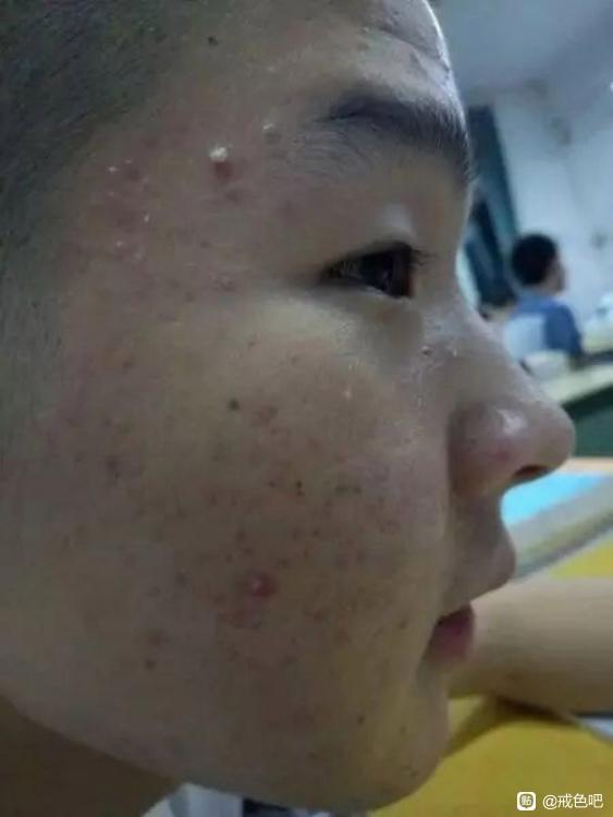 ”这件事，真的让我一脸痘痘消失了！！！