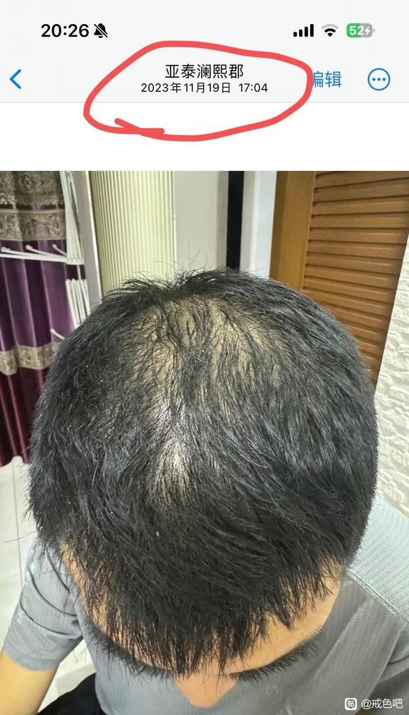 ”之前手yz造成的脱发终于治好了