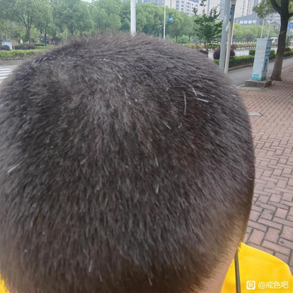 ”白头发还能恢复吗