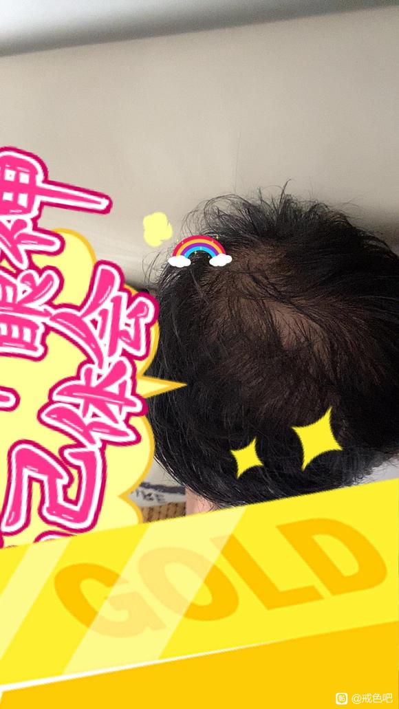 ”救命头发掉没了